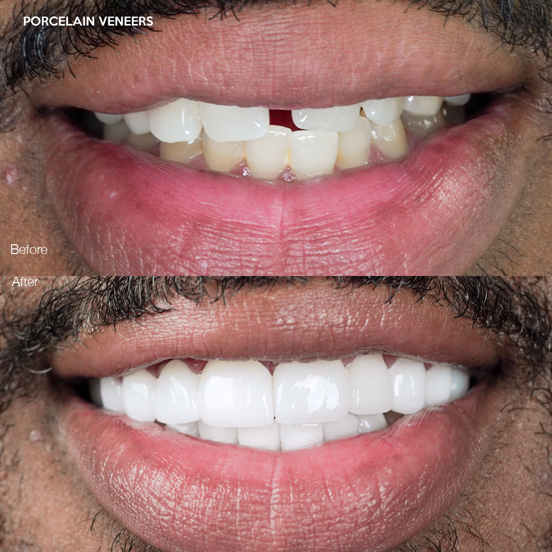 Case 527, porcelain veneers smile transformation Miami