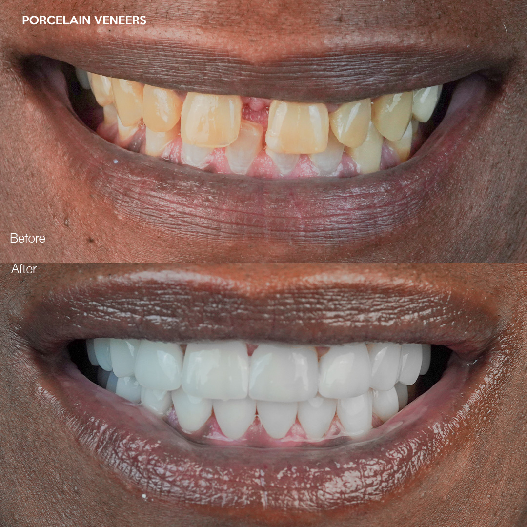 Case 540, custom porcelain veneers result, Svelta Dental Miami