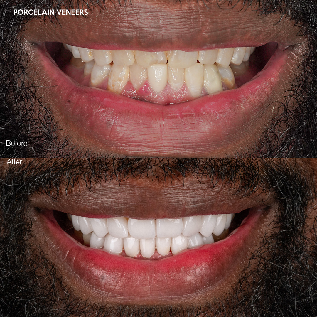 Case 542, porcelain veneers before and after, Miami