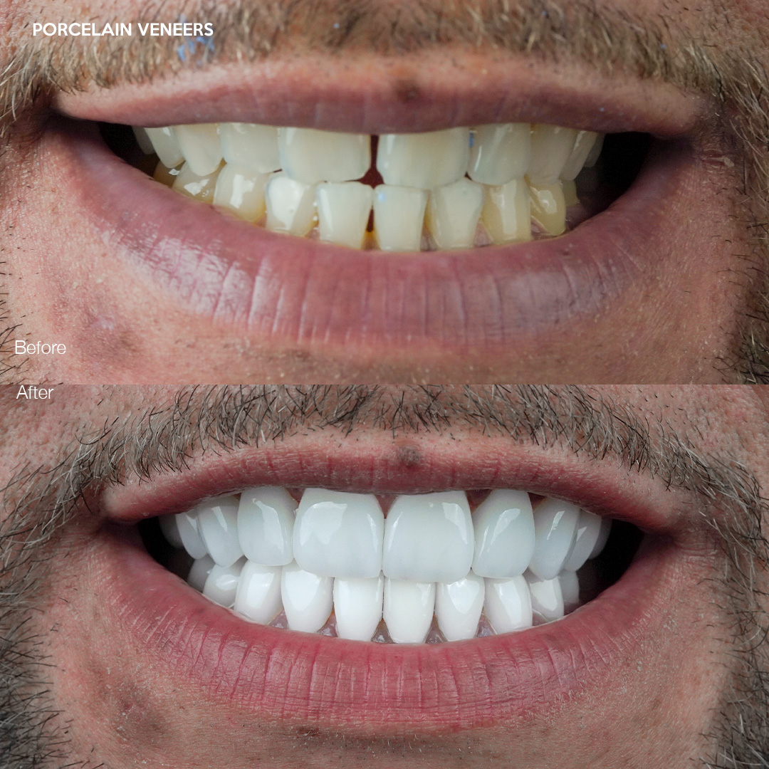 Case 544, porcelain veneer smile makeover, Svelta Dental Design