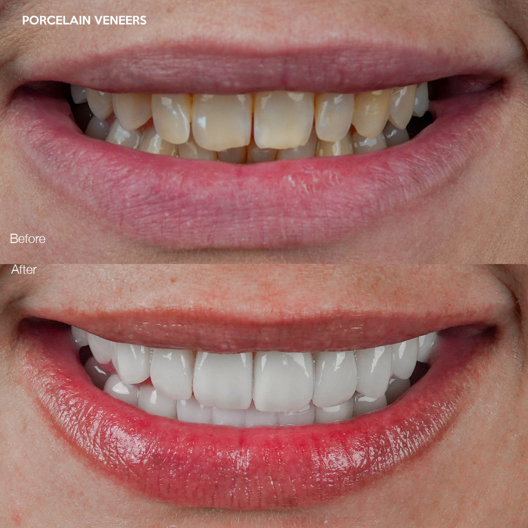 Case 549, porcelain veneers transformation, Miami cosmetic dentist