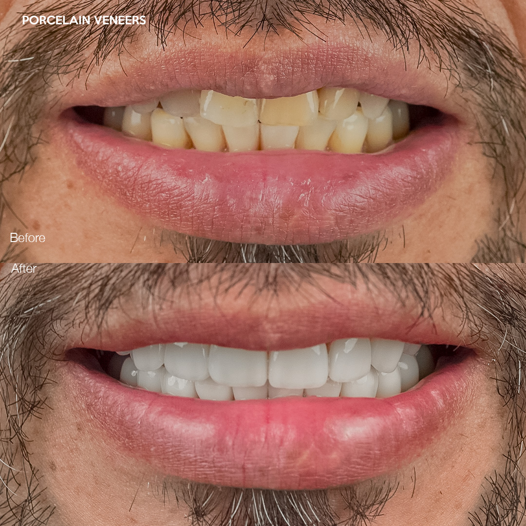 Case 550, full smile makeover with porcelain veneers, Svelta Dental