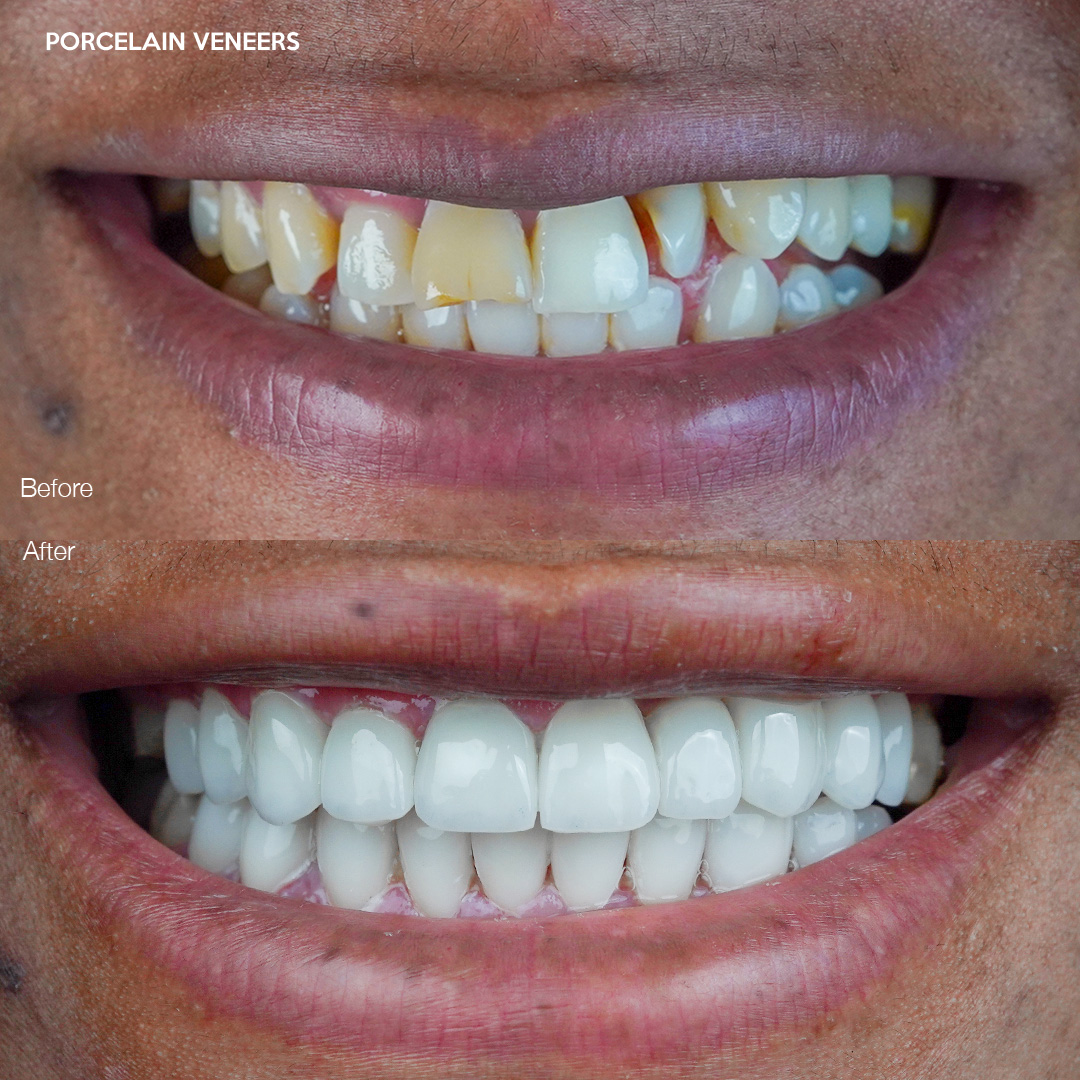 Case 557, custom porcelain veneers result, Miami dental studio