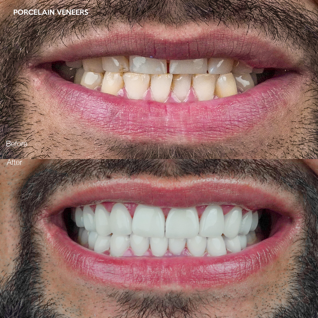 Case 572, porcelain veneers smile transformation, Svelta Dental Design