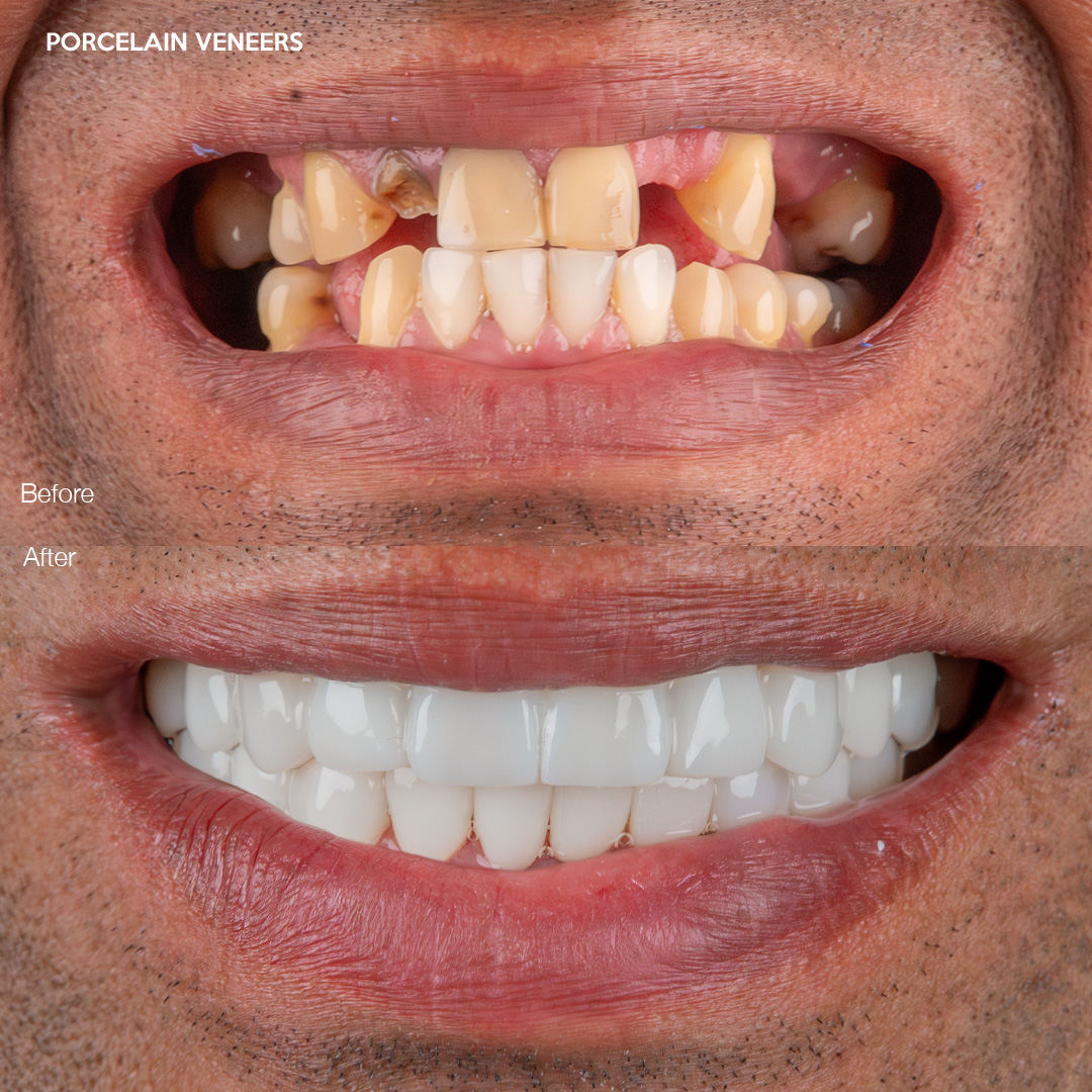 Case 586, porcelain veneers cosmetic result, Svelta Dental Miami