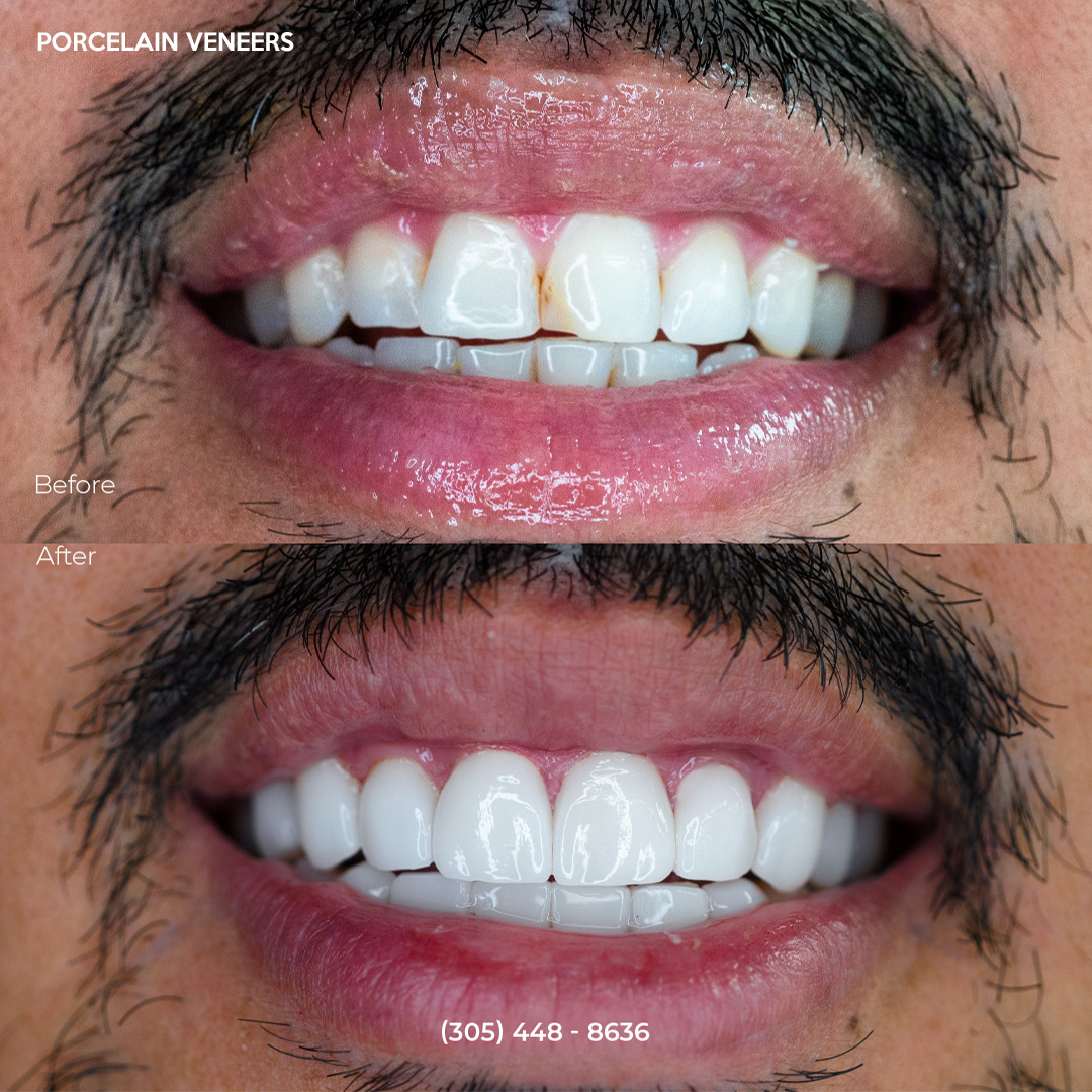 Custom porcelain veneers before and after, full smile makeover Miami