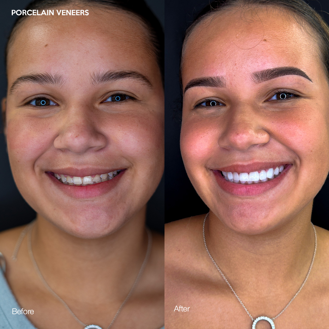 Porcelain veneers natural finish and translucency, Svelta Dental Miami
