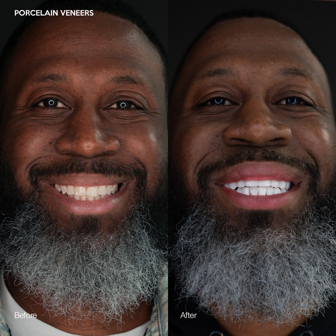 Before and after porcelain veneers, Svelta Dental Design Miami patient