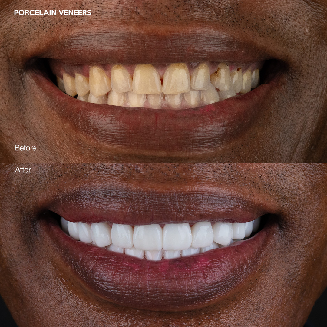 Porcelain veneers smile makeover, Miami dental studio result