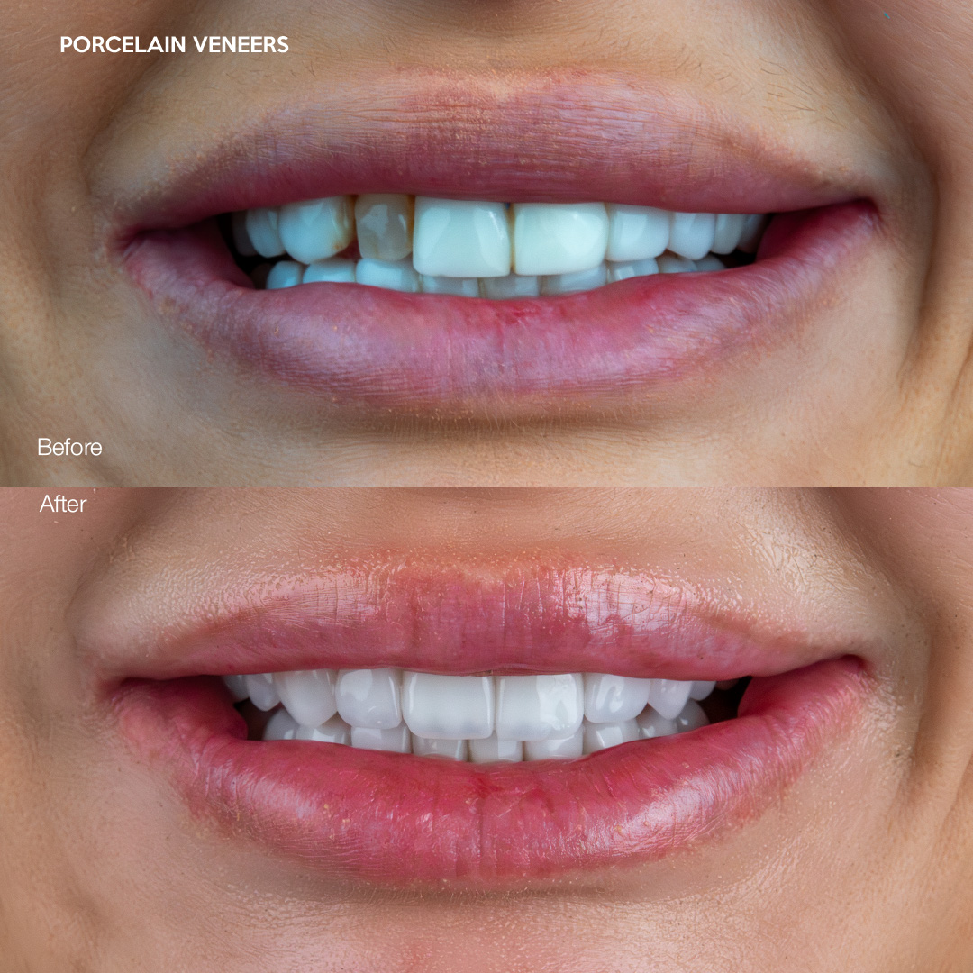 Porcelain veneers close-up, precision cosmetic dentistry Miami
