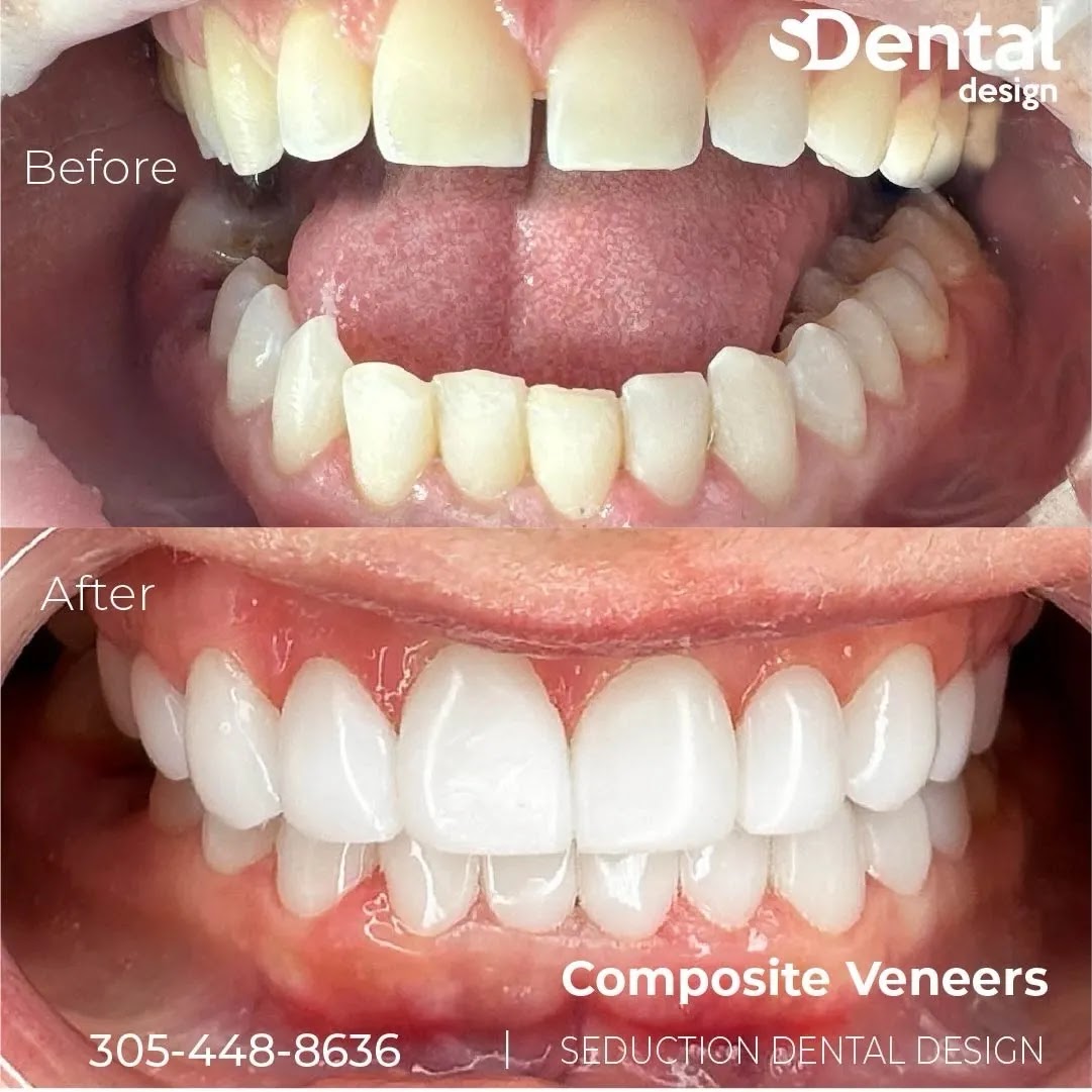Composite veneers before and after at Svelta Dental Design