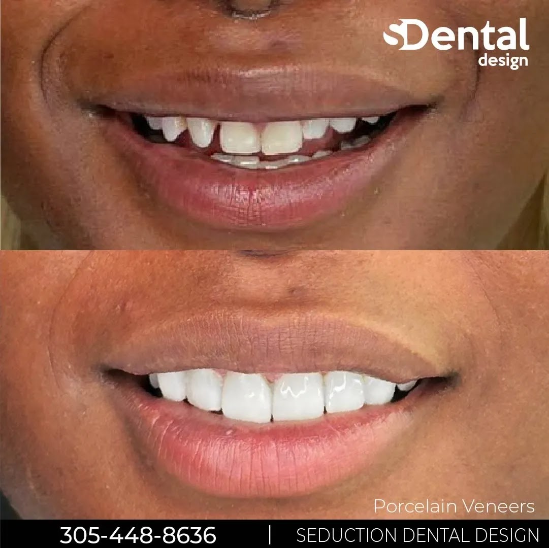 Porcelain veneers before and after at Svelta Dental Design
