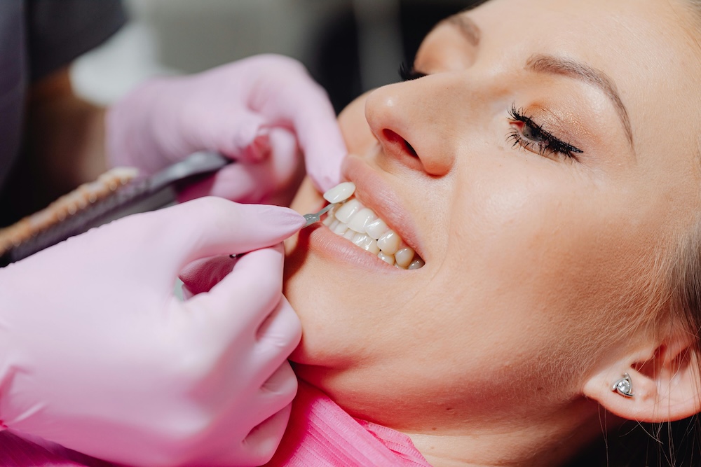 Porcelain veneer placement process at Svelta Dental Design Miami