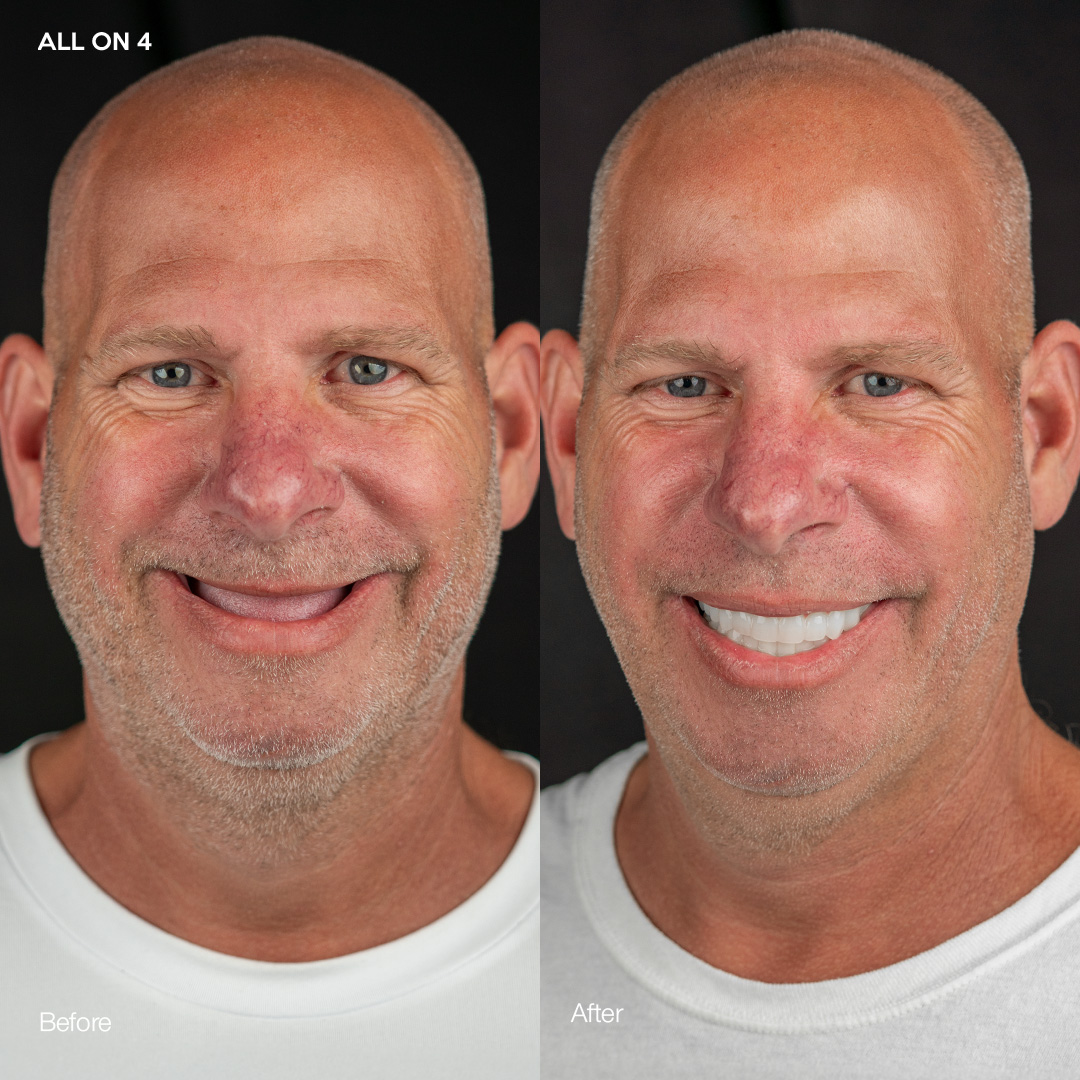 Case 558 alternate view, All-on-4 fixed arch prosthetic, Svelta Dental Design