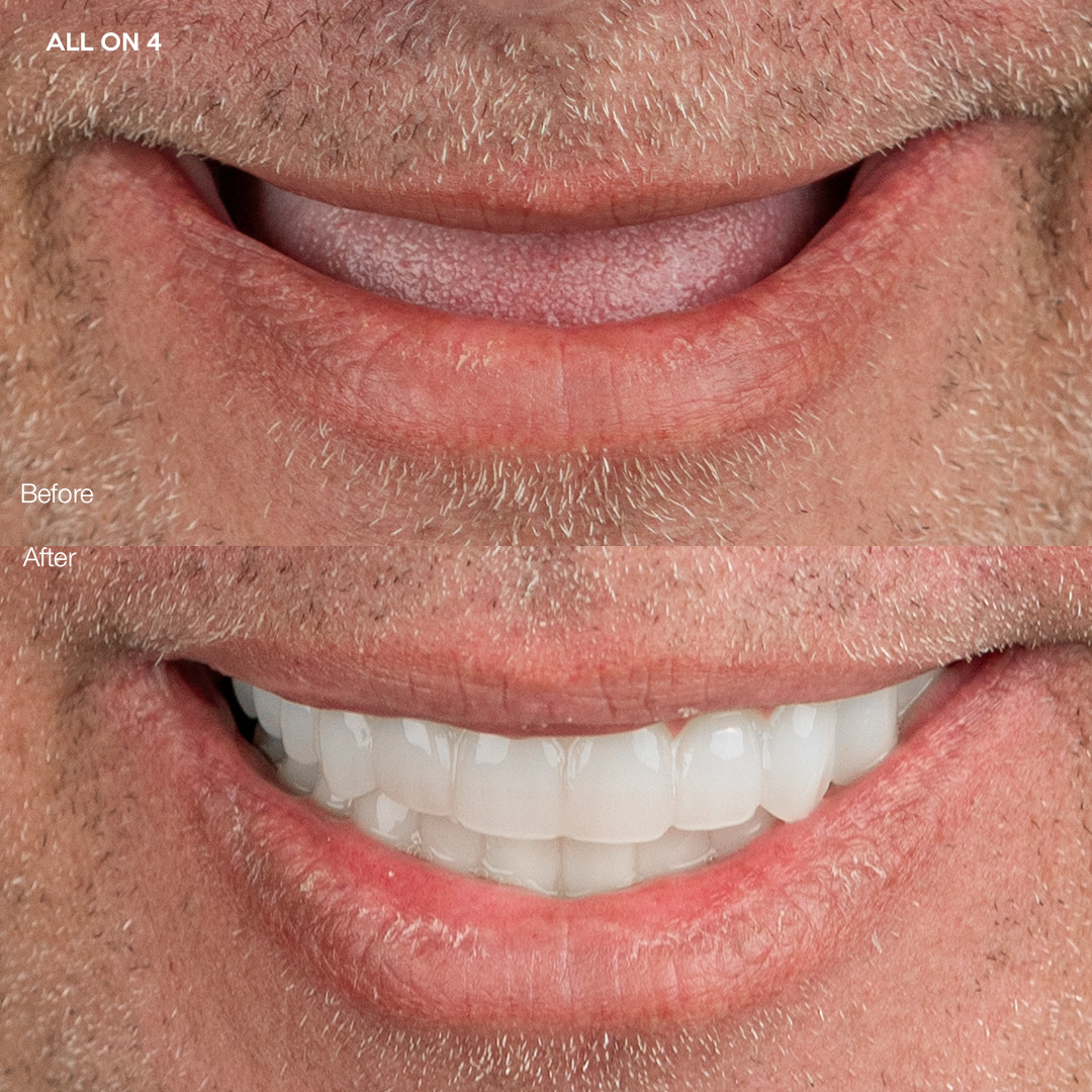 Case 558, All-on-4 dental implants before and after, Svelta Dental Miami