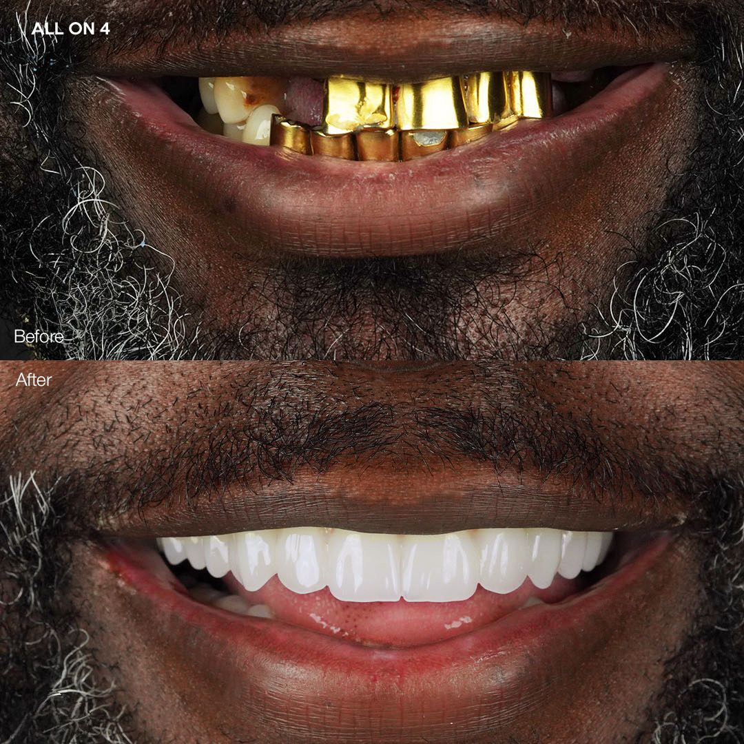 All-on-4 full-arch implant transformation, Svelta Dental Miami