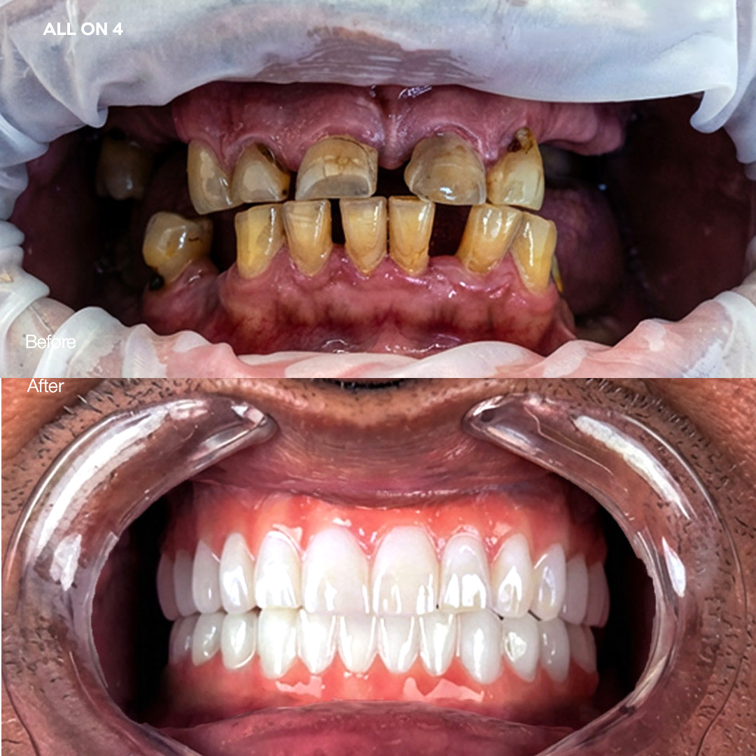 Full-arch implant restoration, Svelta Dental Design