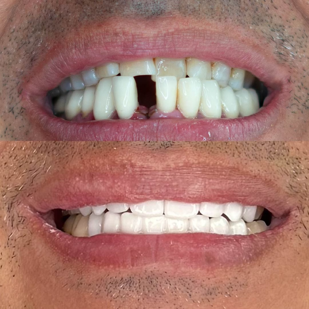 Composite Veneers