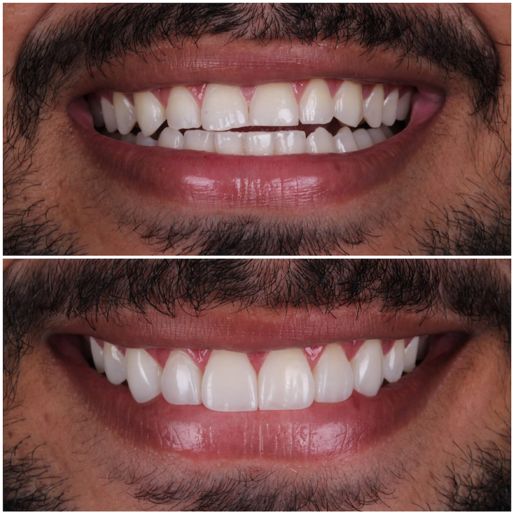Composite Veneers