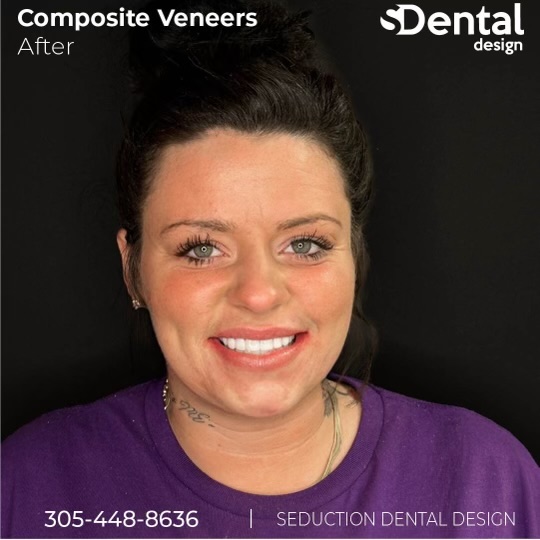Composite Veneers