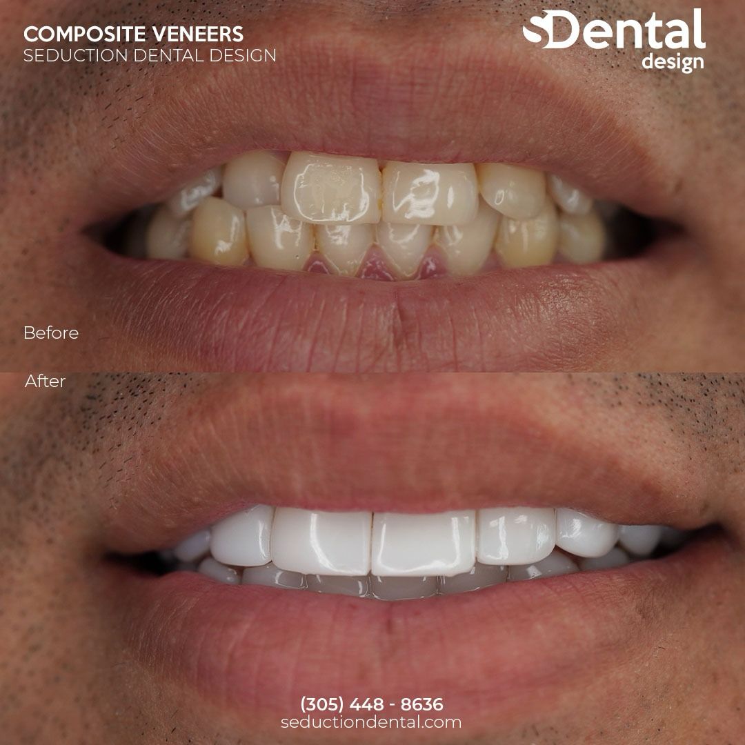 Composite Veneers