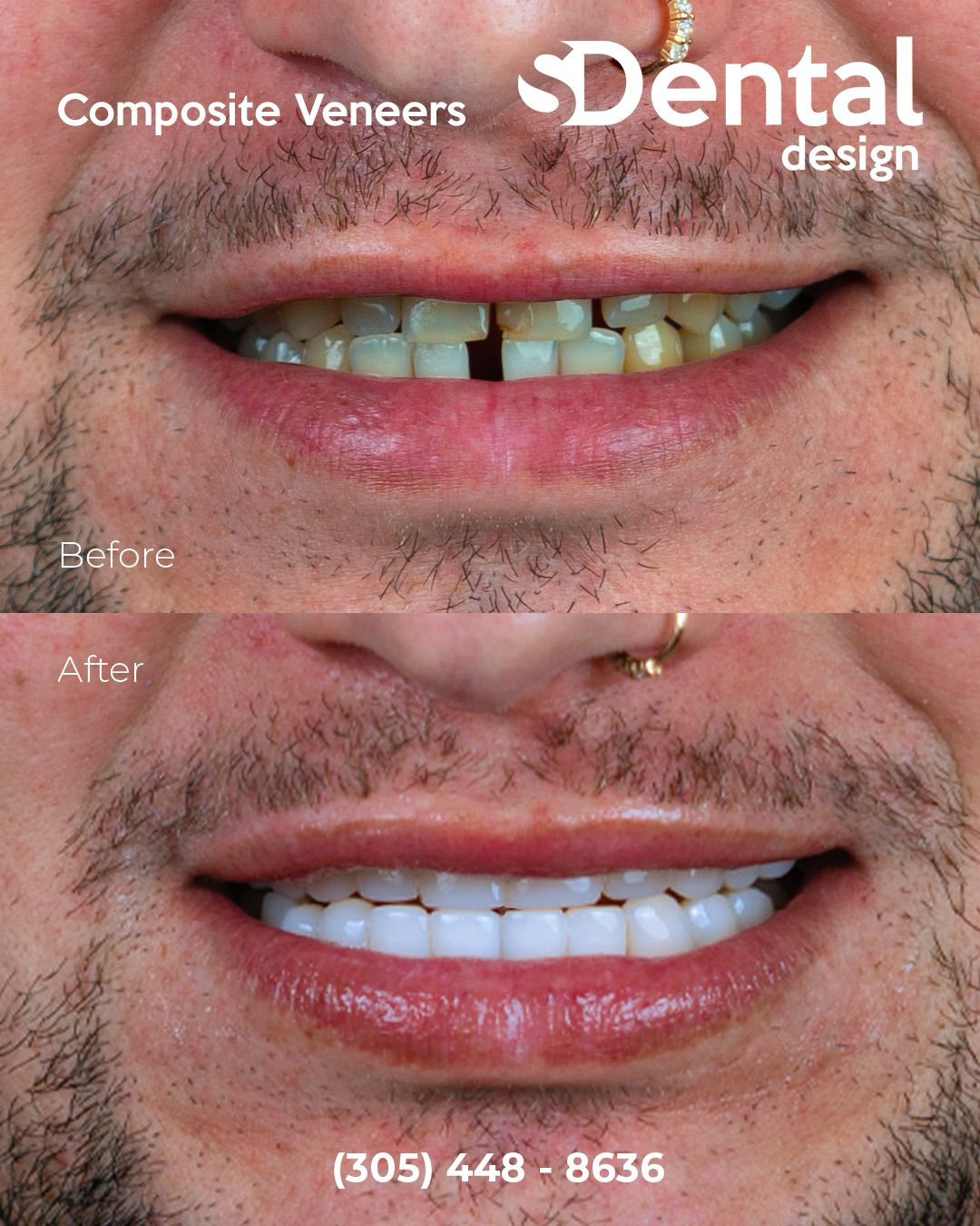Same-day composite veneers result — full smile makeover, Svelta Dental