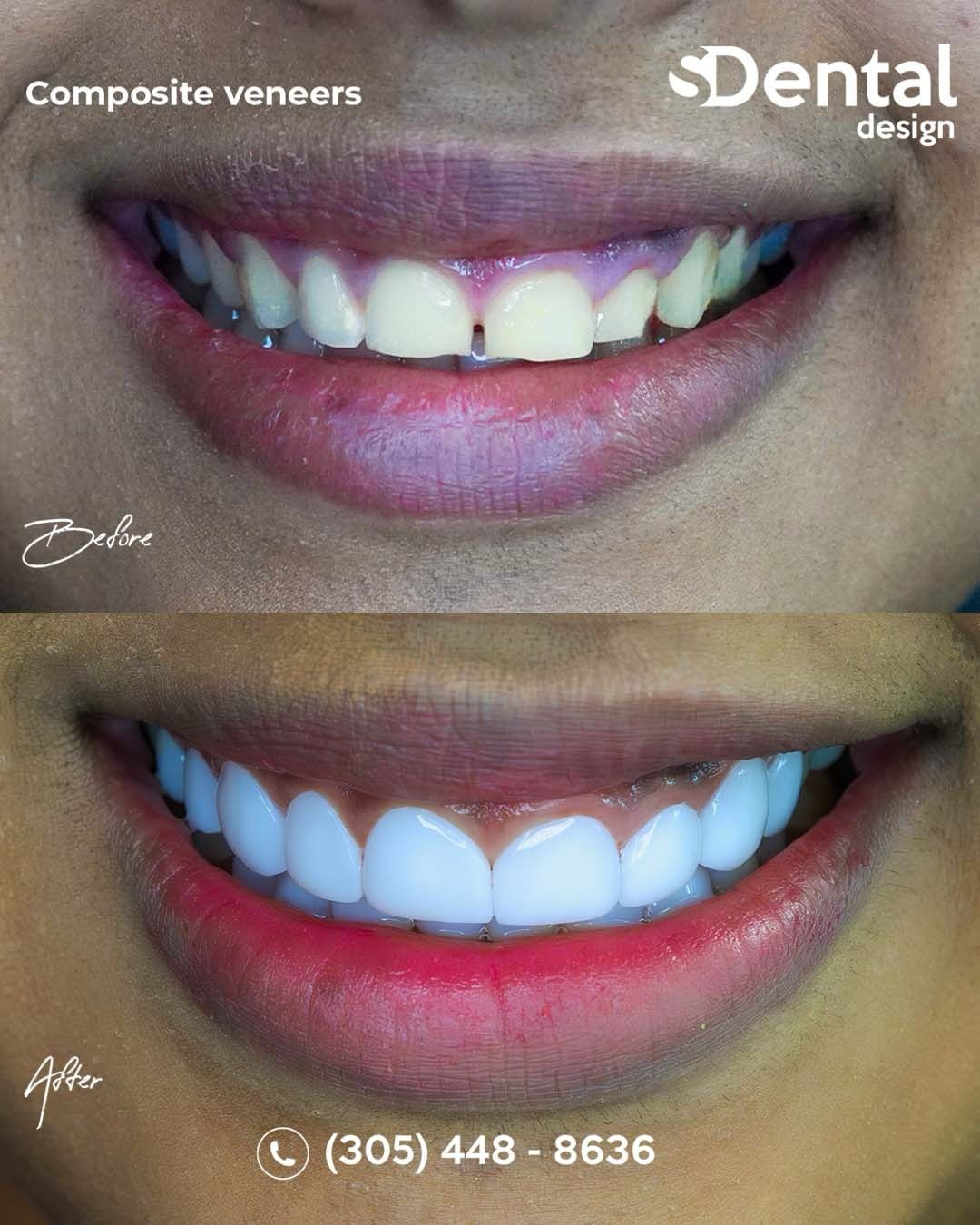 Composite resin veneers close-up — natural finish, Svelta Dental Design