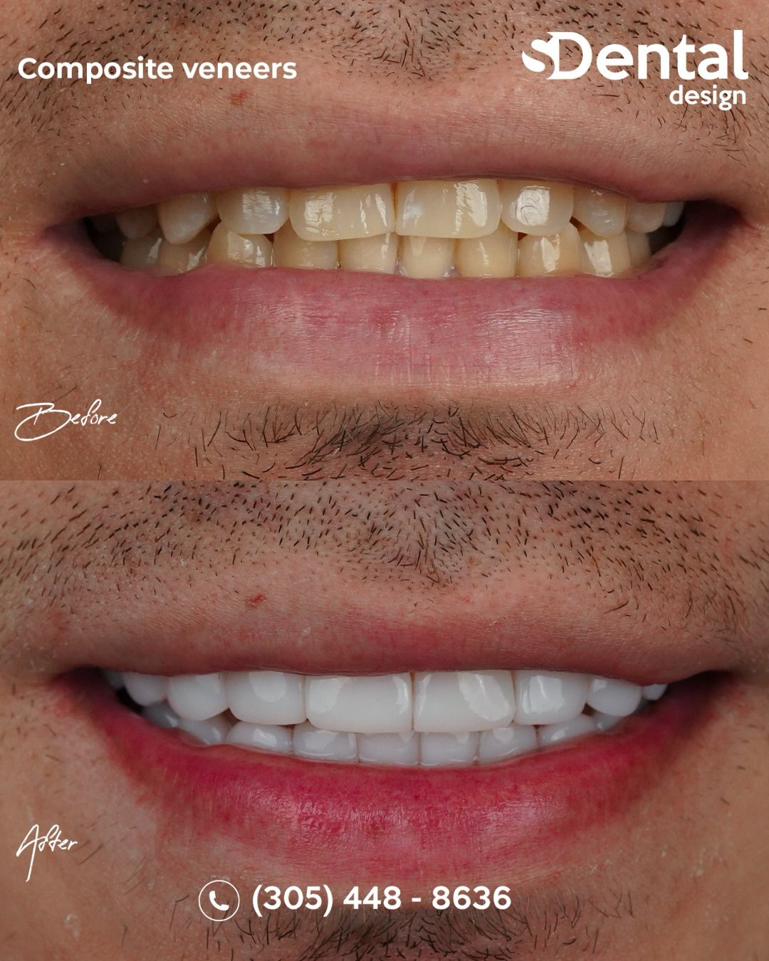 Composite Veneers