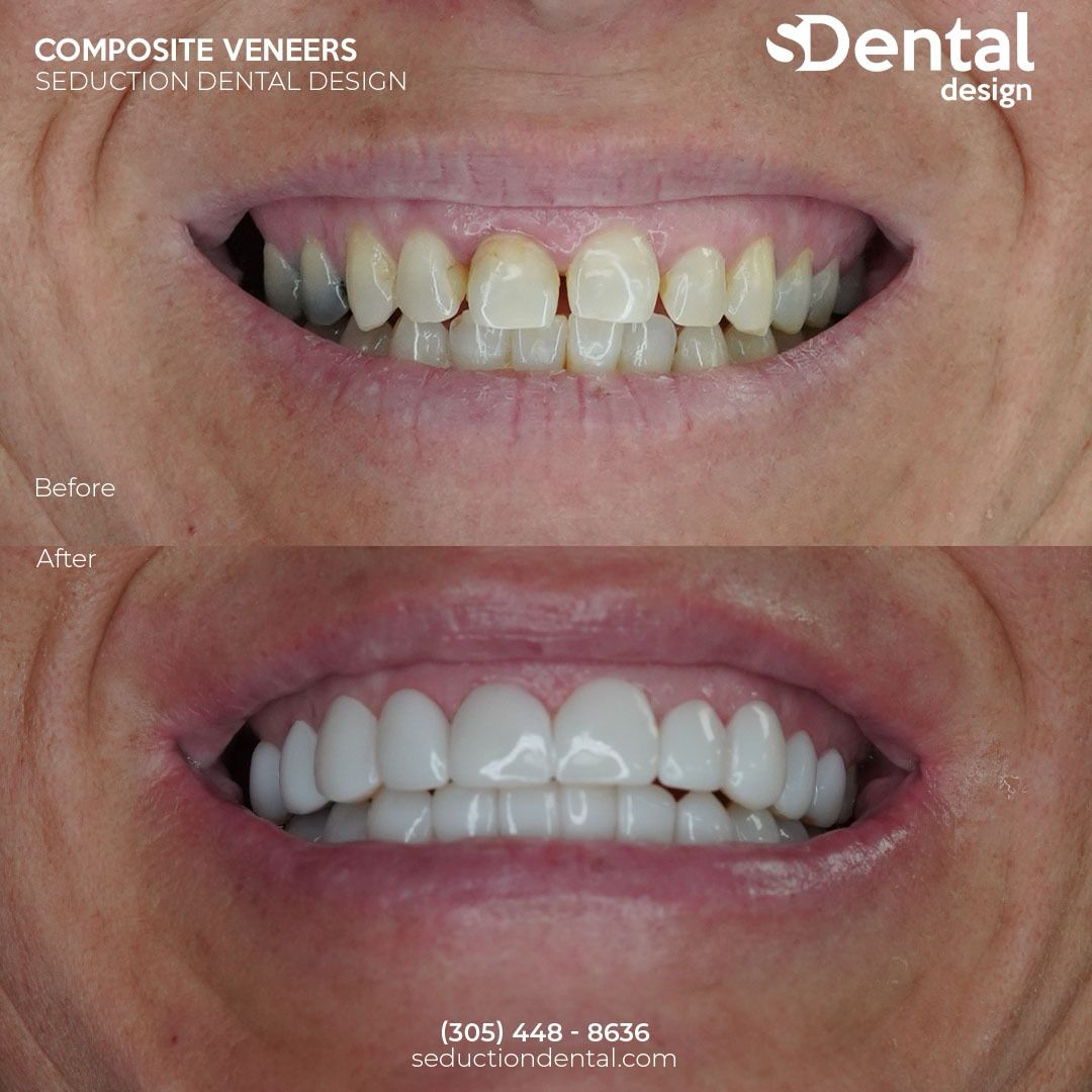 Composite Veneers