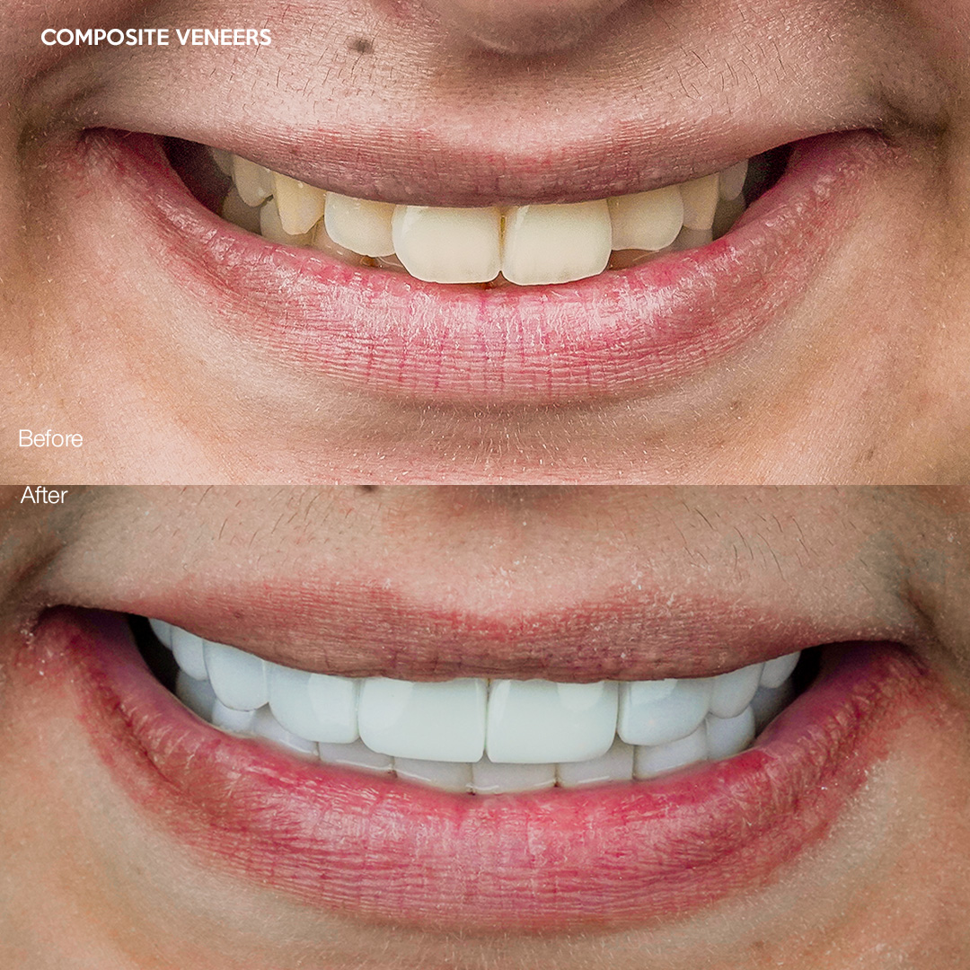 Composite veneer transformation, Svelta Dental Design Miami
