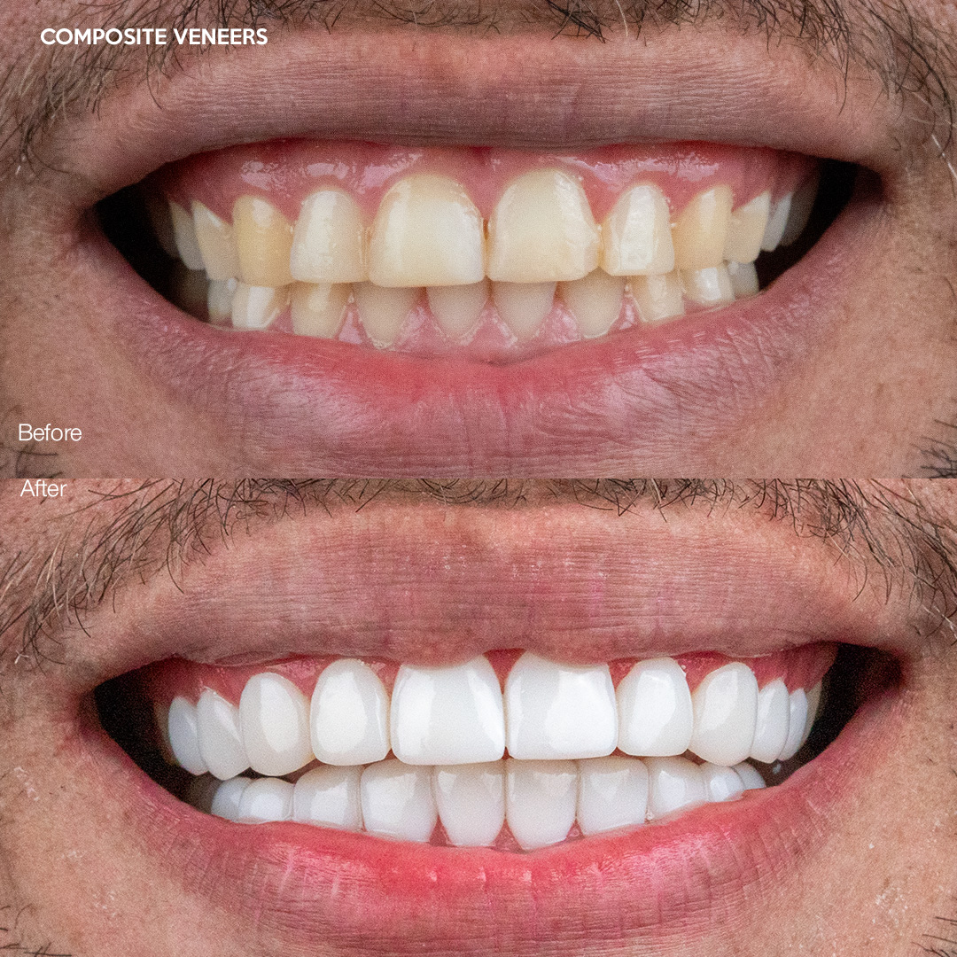 Same-day composite veneers, Svelta Dental