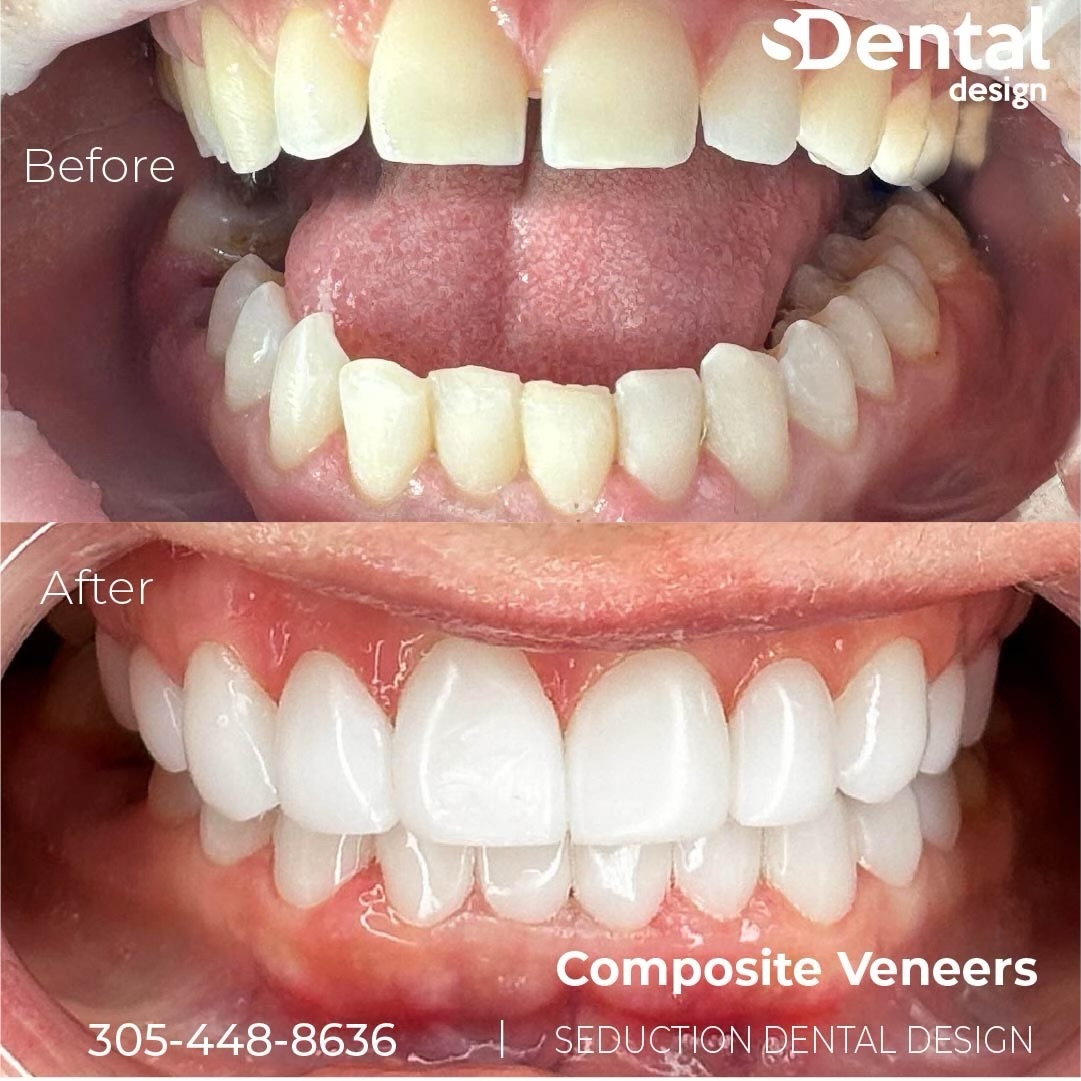 Composite Veneers