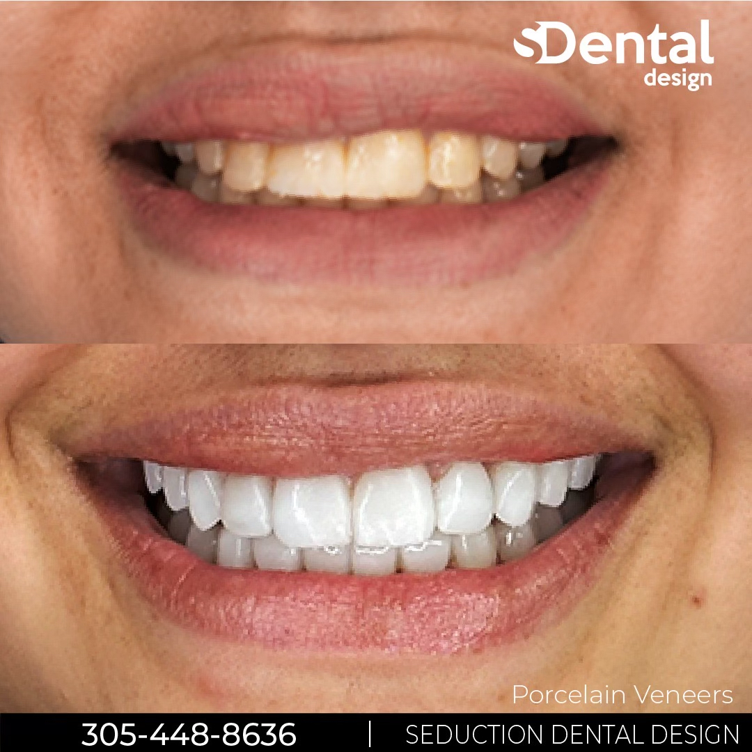 Porcelain Veneers