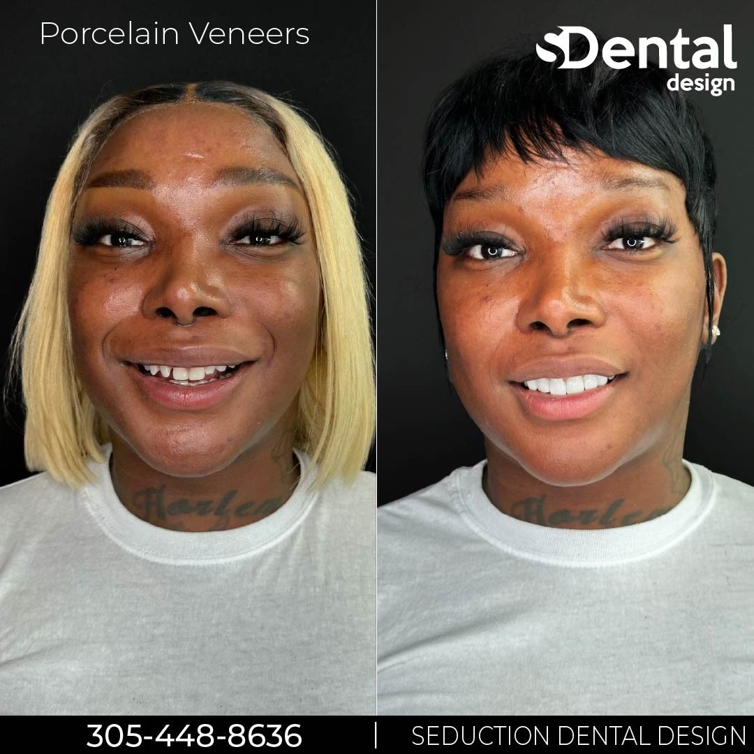 Porcelain Veneers