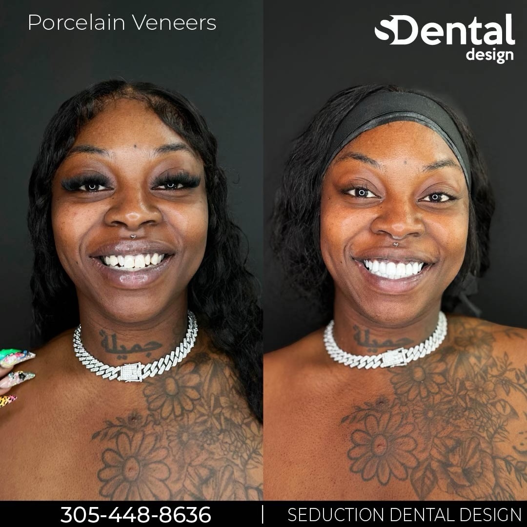 Porcelain Veneers