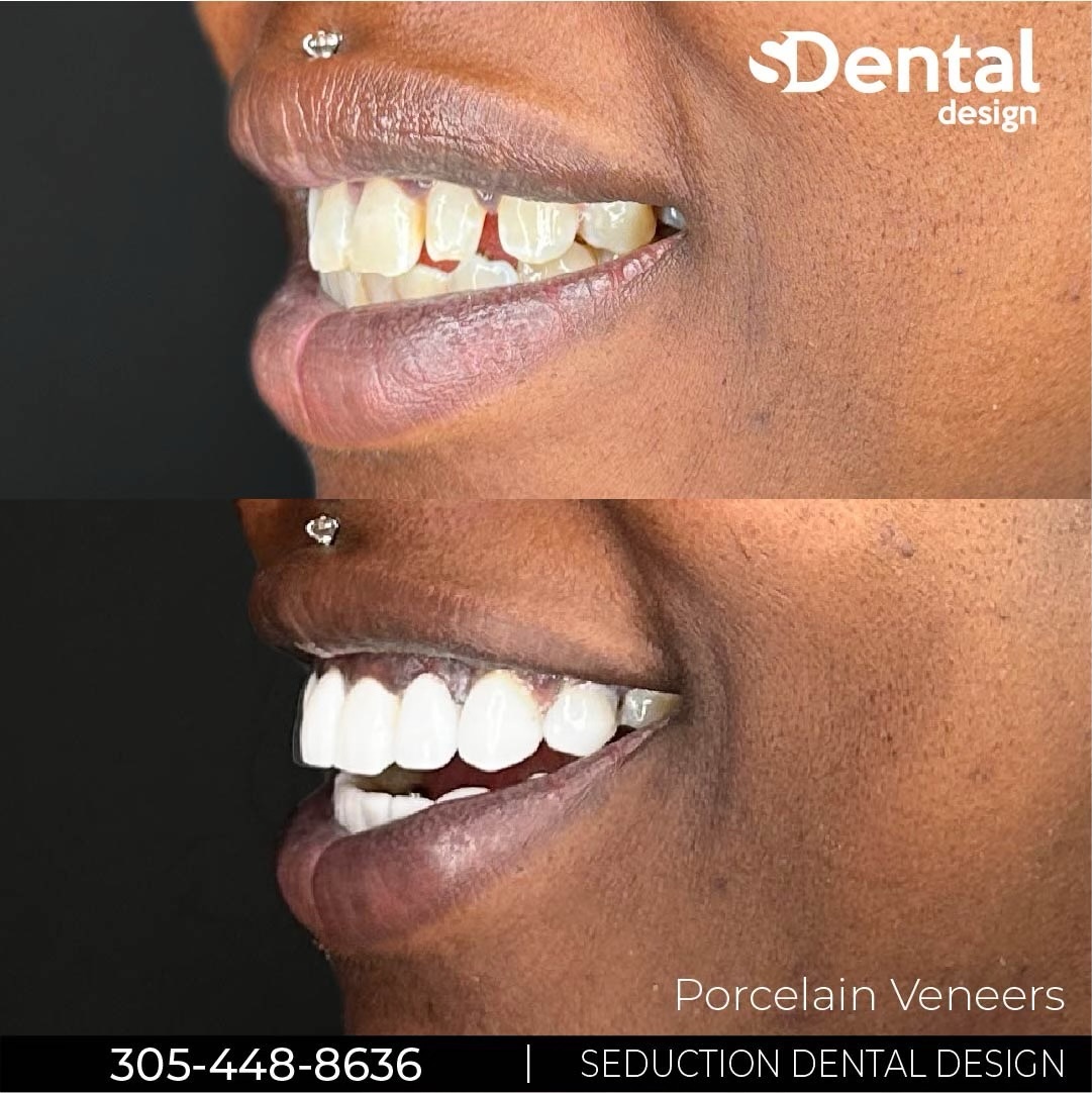 Porcelain Veneers