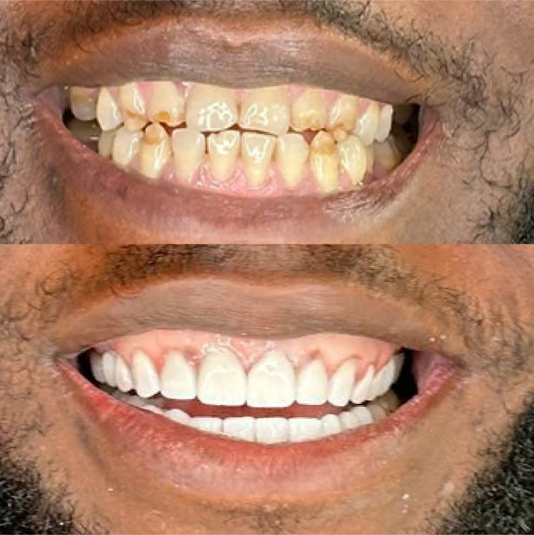 Porcelain Veneers