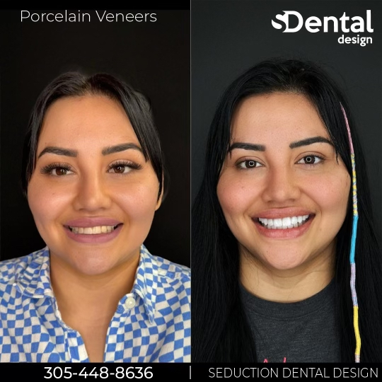 Porcelain Veneers