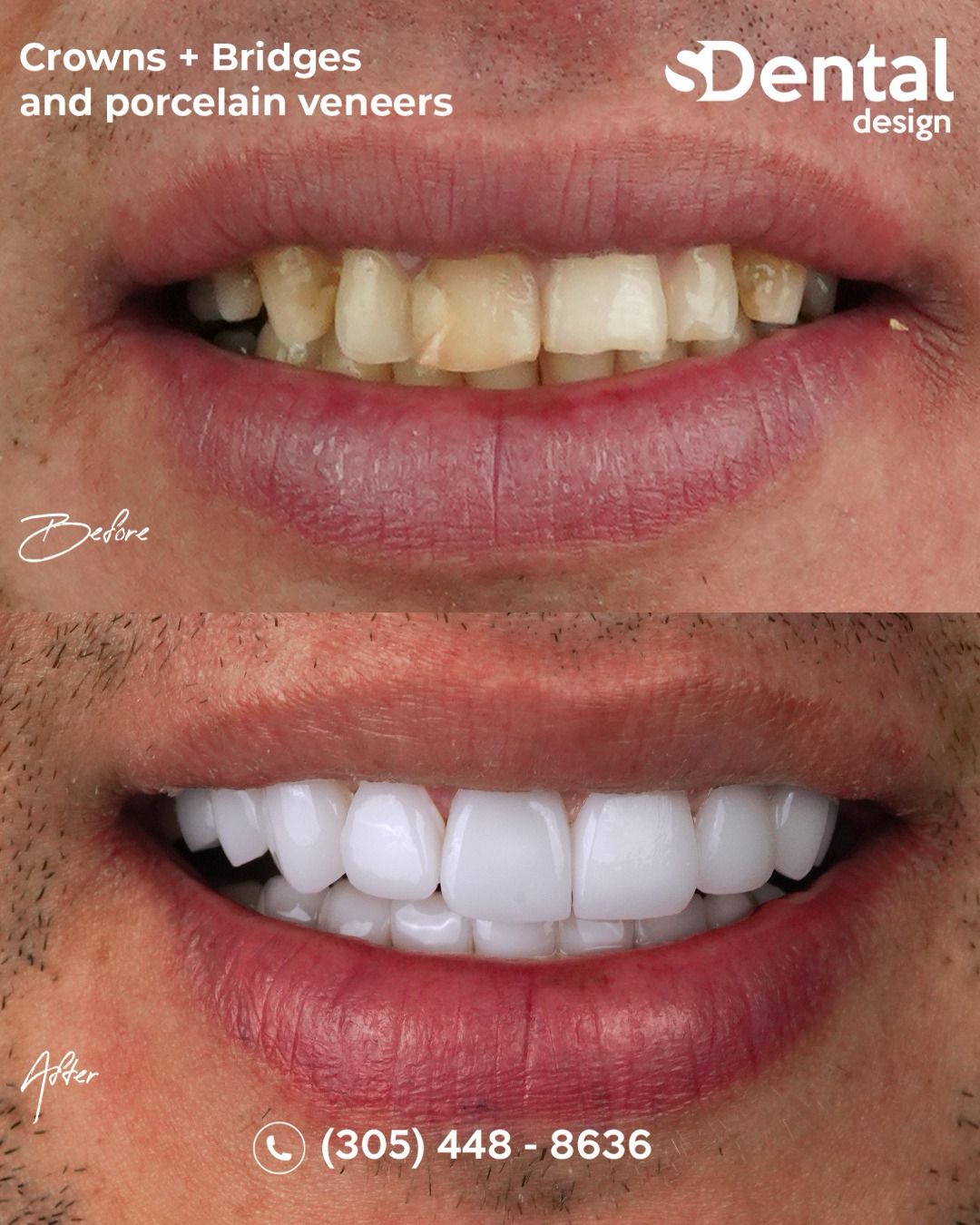 Porcelain Veneers
