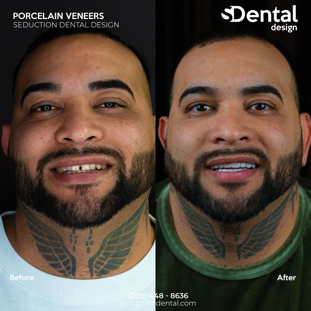 Porcelain Veneers