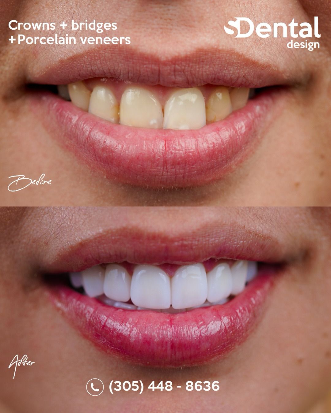 Porcelain Veneers