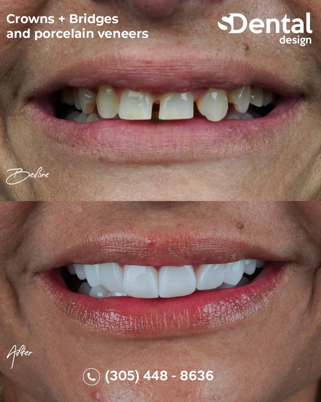 Porcelain Veneers