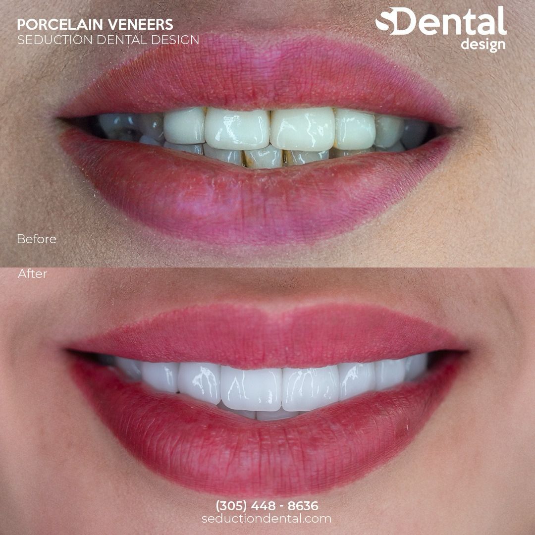 Porcelain Veneers