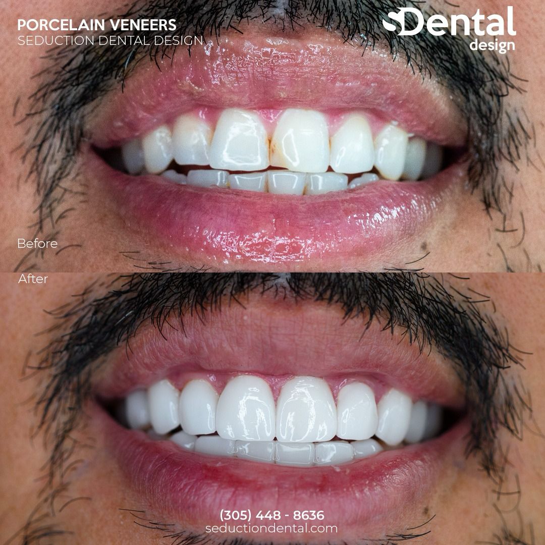 Porcelain Veneers