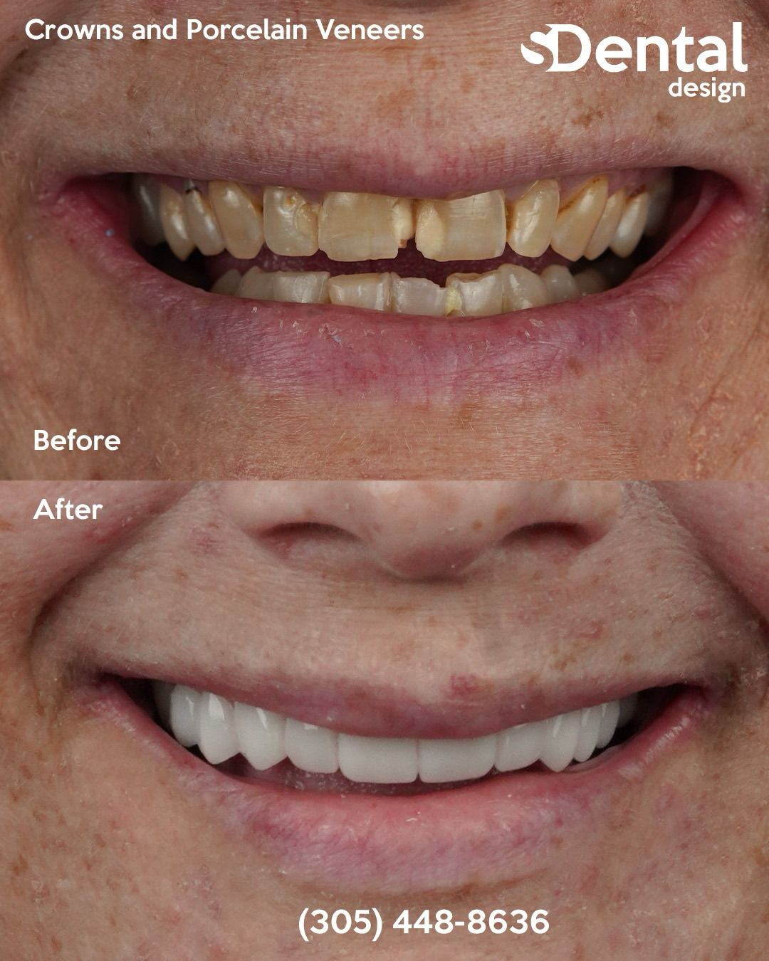 Porcelain Veneers