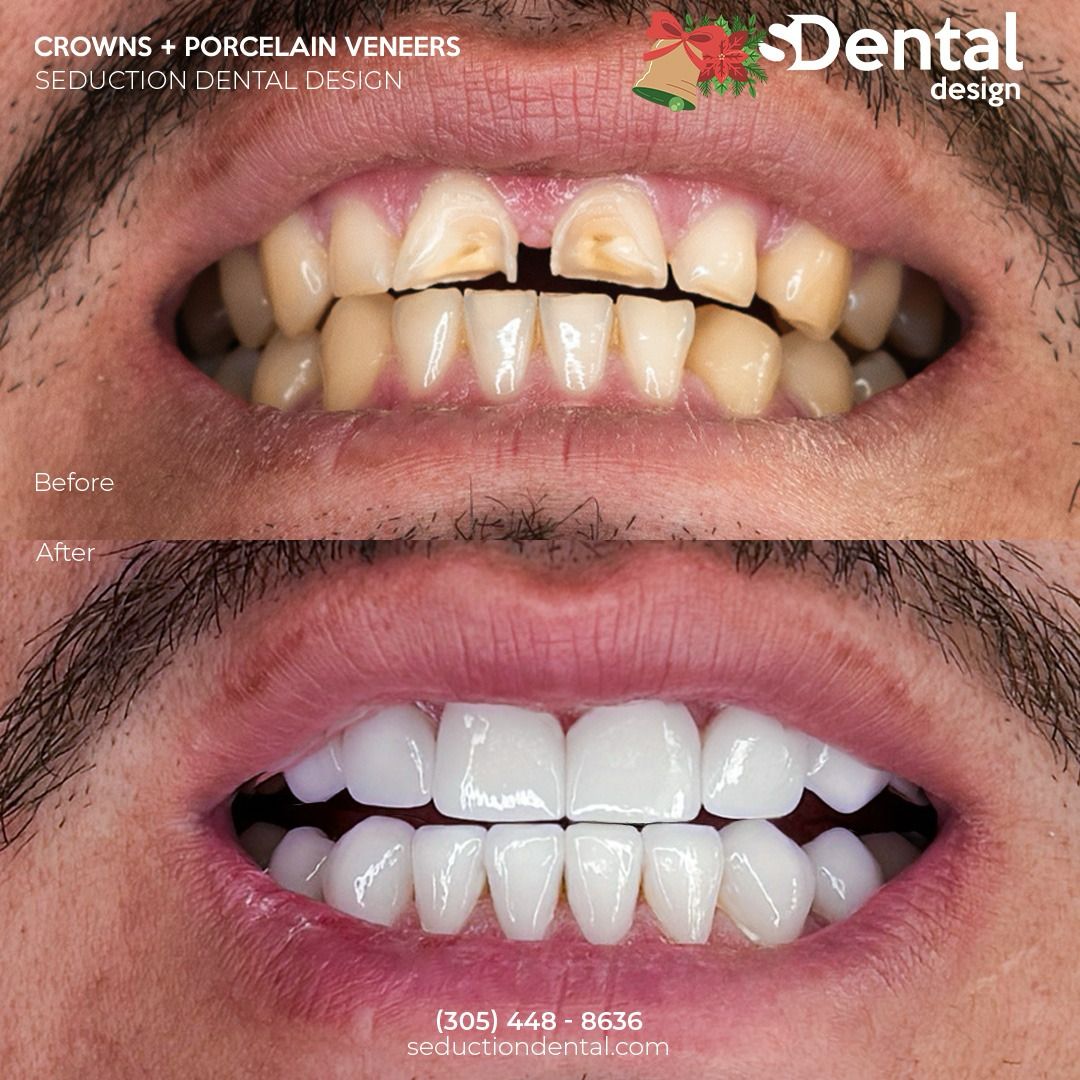 Porcelain Veneers