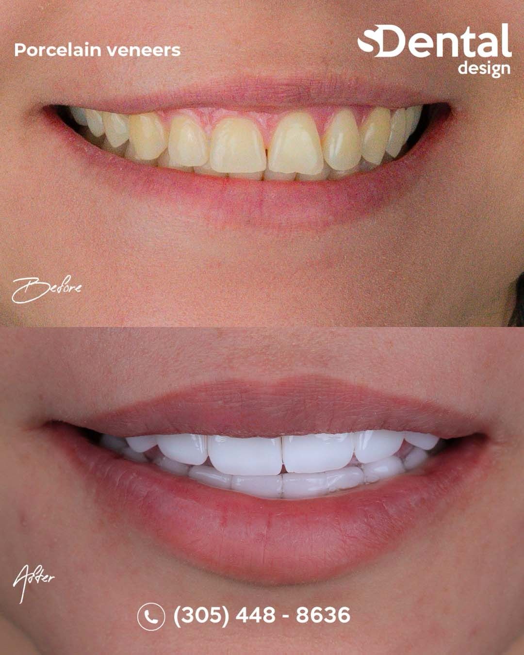Porcelain Veneers