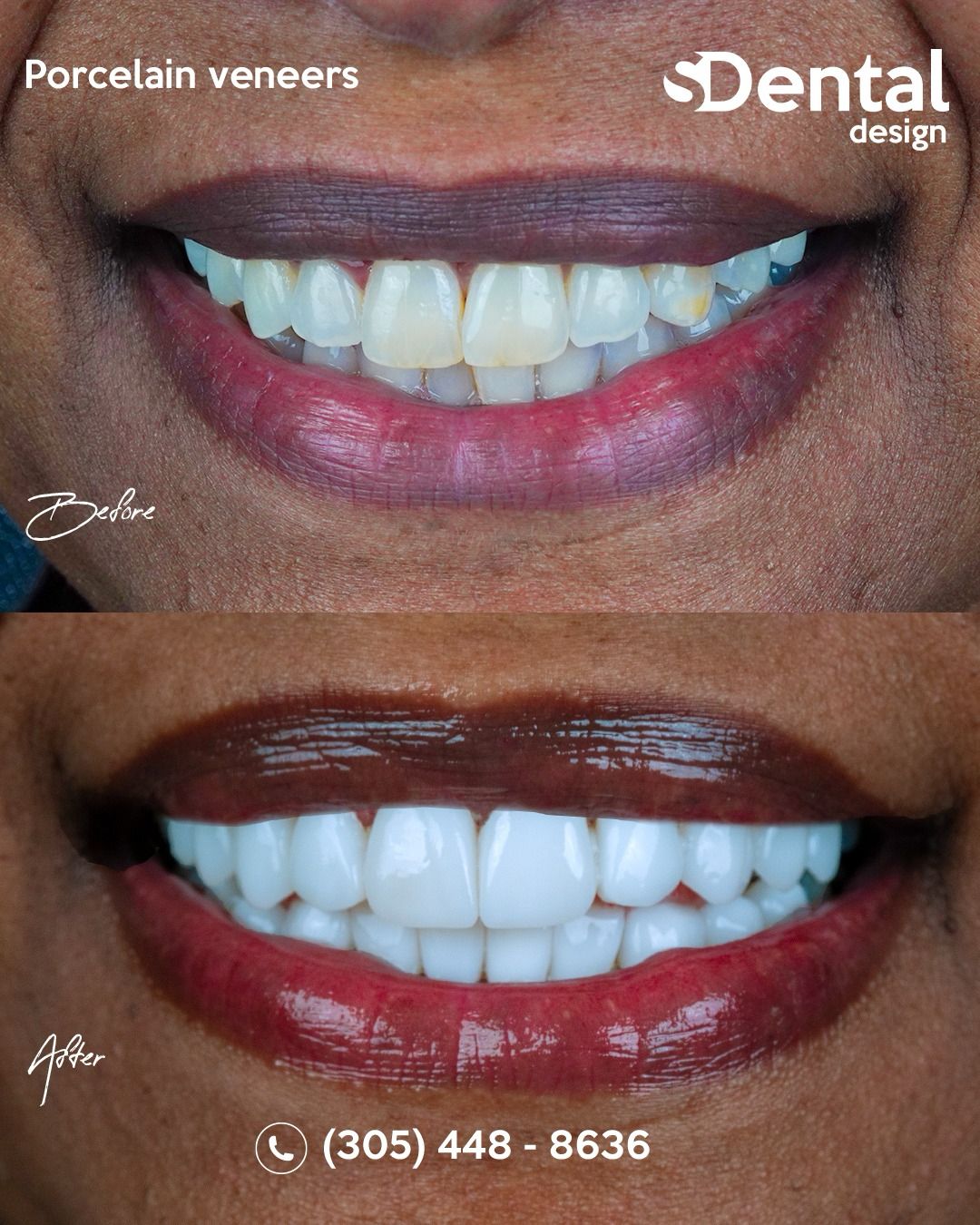Porcelain Veneers