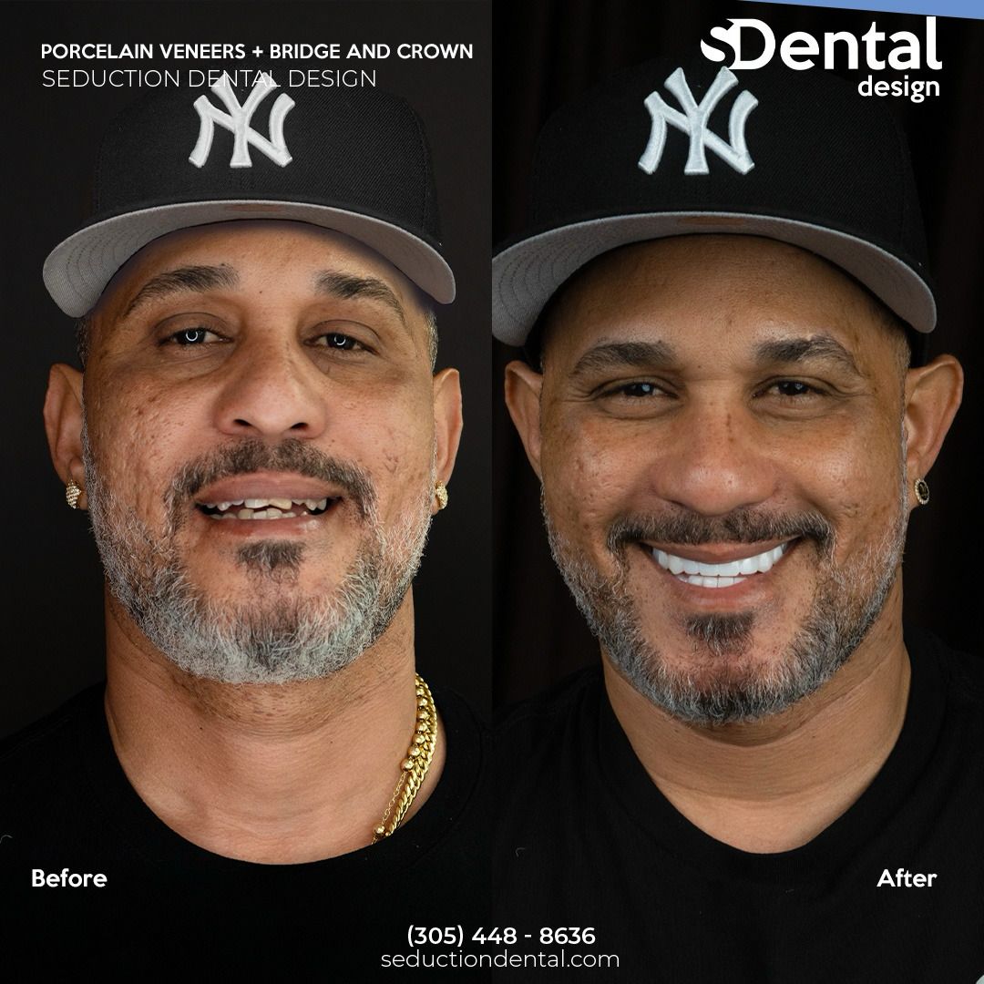 Porcelain Veneers