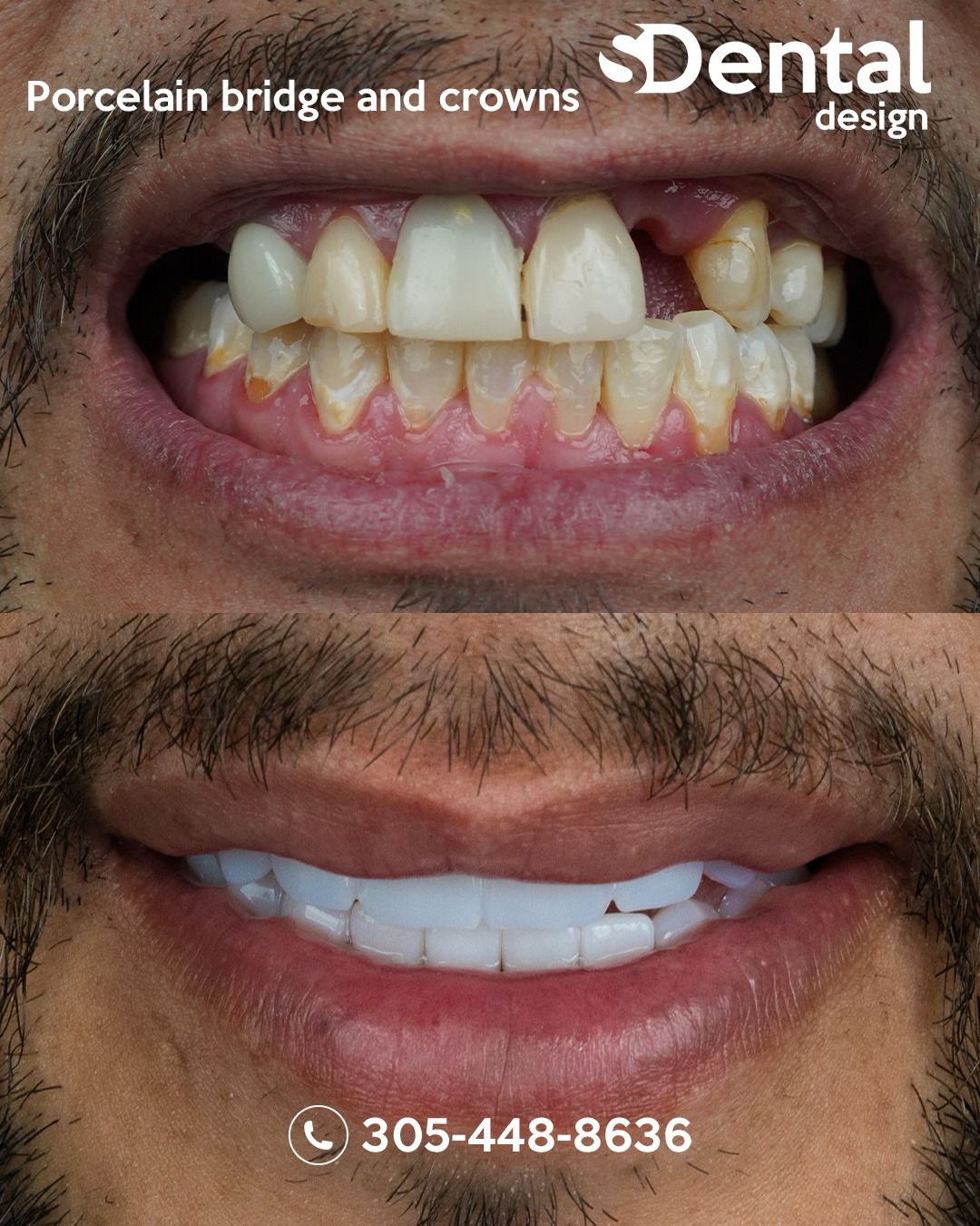 Full smile makeover with custom porcelain veneers — Svelta Dental Miami